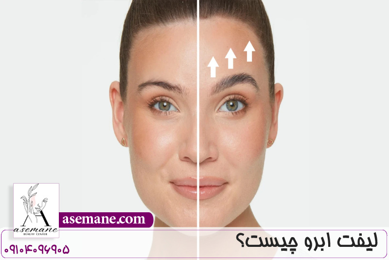 لیفت ابرو چیست؟ 