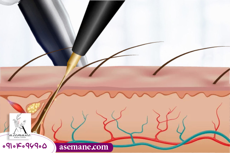تاثیر کوتاه یا بلند بودن مو بر نتیجه لیزر