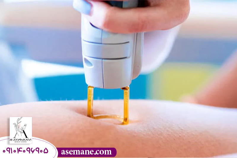 مزایای رعایت اندازه مناسب مو در لیزر موهای زائد