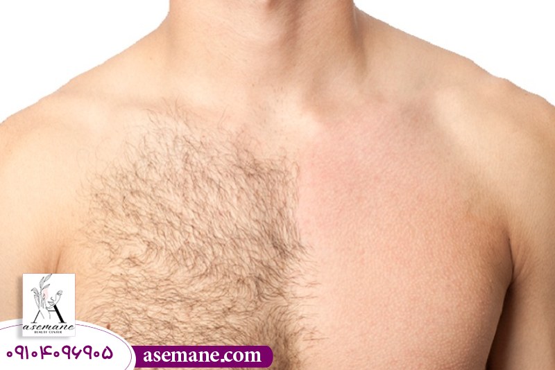 تاثیر هورمون ها و مشکلات داخلی بدن بر بازگشت مو