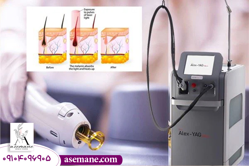 تاثیر نوع دستگاه لیزر در جلوگیری از رشد مجدد موهای زائد